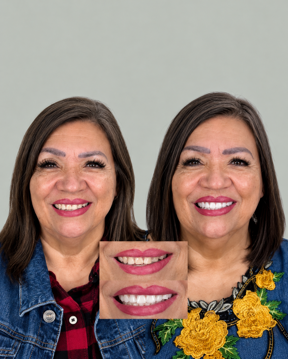 Diseño de Sonrisa - Antes y Después