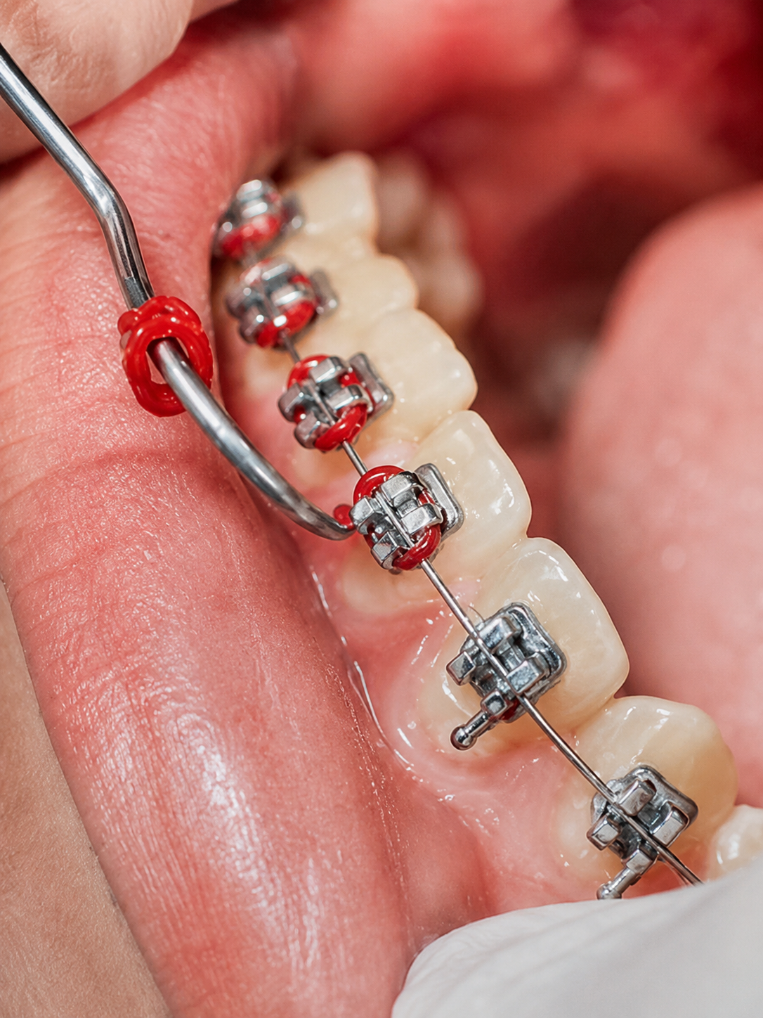 Brackets dentales