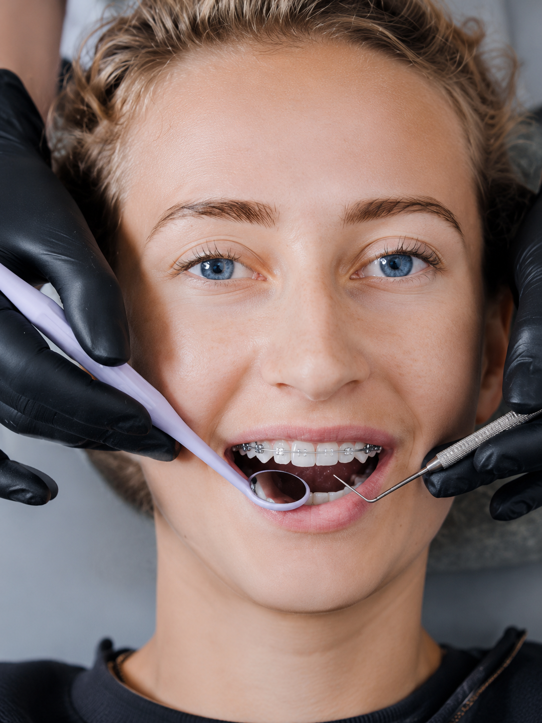 Ortodoncia - Brackets