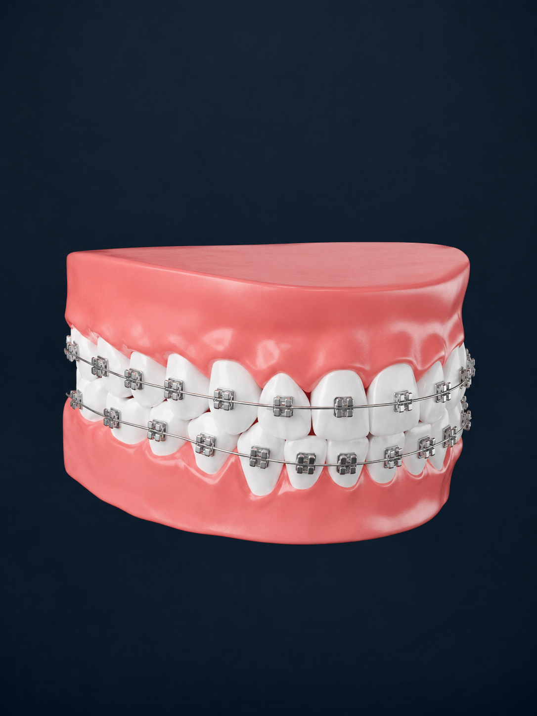 Modelo de brackets